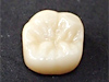 クローバー歯科東大島の審美治療
