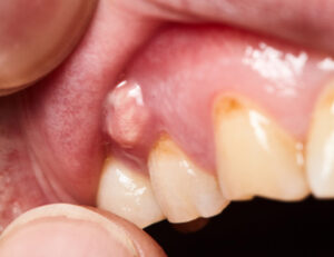 東大島（江東区）の歯医者、クローバー歯科東大島で歯ぐきが腫れているのに痛くないときの原因について解説