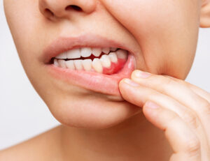 東大島（江東区）の歯医者、クローバー歯科東大島で歯ぐきが腫れているのに痛くないときの原因について解説