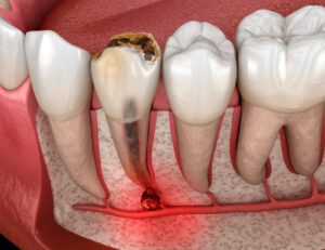 東大島（江東区）の歯医者、クローバー歯科東大島で歯ぐきが腫れているのに痛くないときの原因について解説