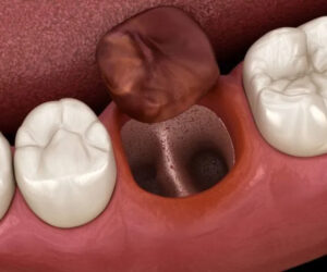 東大島（江東区）の歯医者、クローバー歯科東大島で抜歯後の穴に食べ物が詰まる問題の対処法を解説