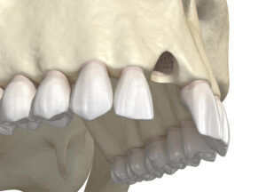 東大島（江東区）の歯医者、クローバー歯科東大島で抜歯後の穴に食べ物が詰まる問題の対処法を解説