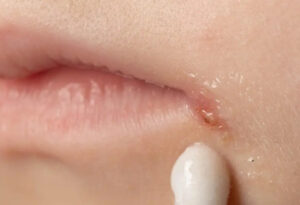 東大島（江東区）の歯医者、クローバー歯科東大島でウイルス性口内炎とは？ほかの口内炎との違いや原因を解説