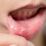 東大島（江東区）の歯医者、クローバー歯科東大島でウイルス性口内炎とは？ほかの口内炎との違いや原因を解説