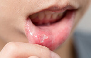 東大島（江東区）の歯医者、クローバー歯科東大島でウイルス性口内炎とは？ほかの口内炎との違いや原因を解説