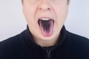 東大島（江東区）の歯医者、クローバー歯科東大島で舌の色や形で分かる口腔内の健康状態を解説