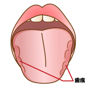 東大島（江東区）の歯医者、クローバー歯科東大島で舌の色や形で分かる口腔内の健康状態を解説