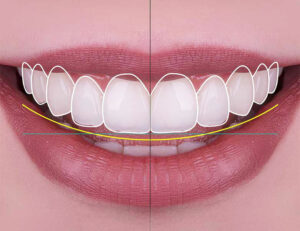 東大島（江東区）の歯医者、クローバー歯科東大島でセラミック矯正のメリットとリスクは？治療方法や歯への影響を解説