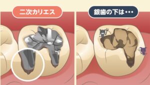 銀歯の寿命は何年？やり直しが必要なサインと二次虫歯の危険性を解説