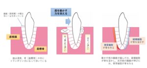 東大島（江東区）の歯医者、クローバー歯科で、抜歯矯正の隙間がなかなか埋まらないのはなぜ？期間が延びる原因と対策を解説